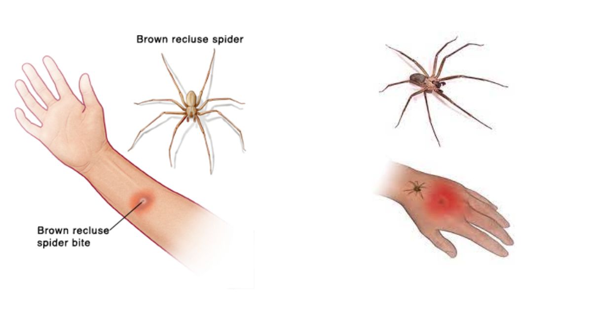 how-long-do-spider-bites-last-diagnosis-treatment